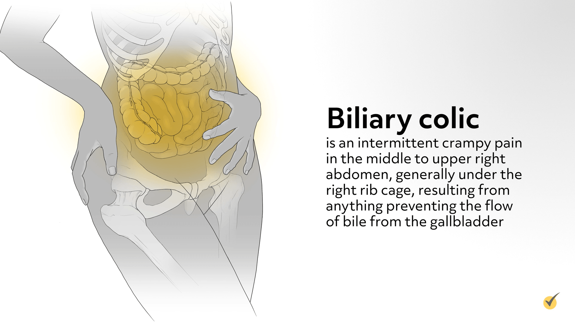 biliary colic