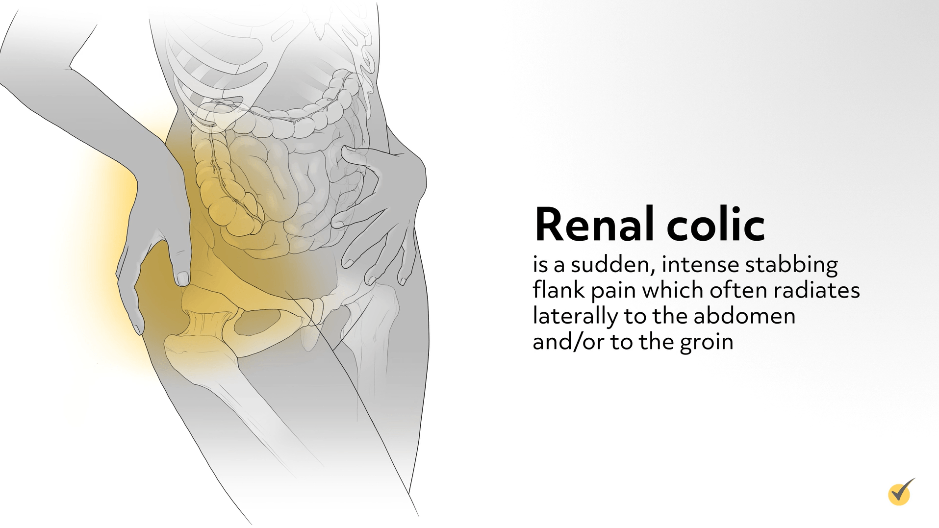 renal colic