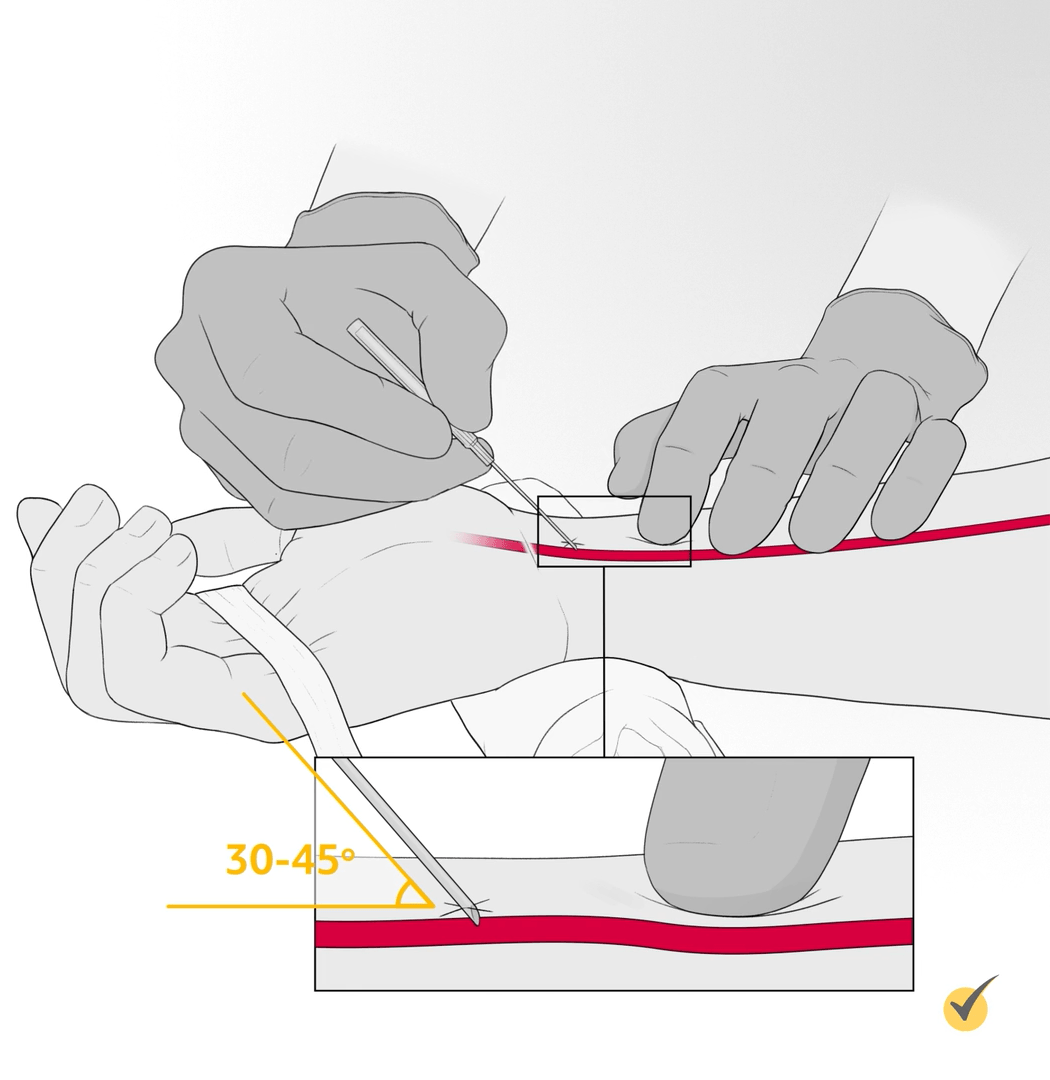 Example of how to execute an arterial puncture. 