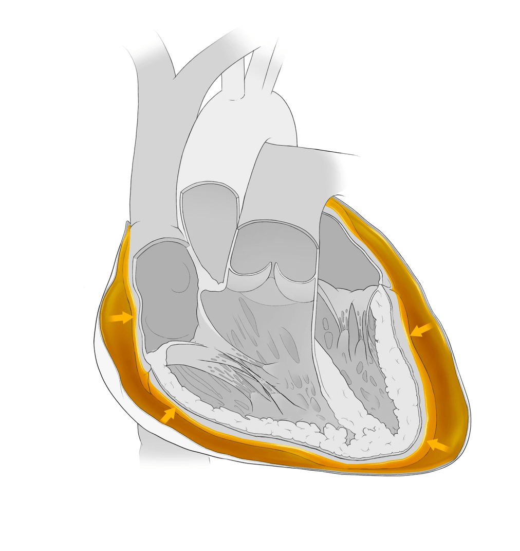 Image of pericardial sack filling with fluid and exerting pressure on the heart.