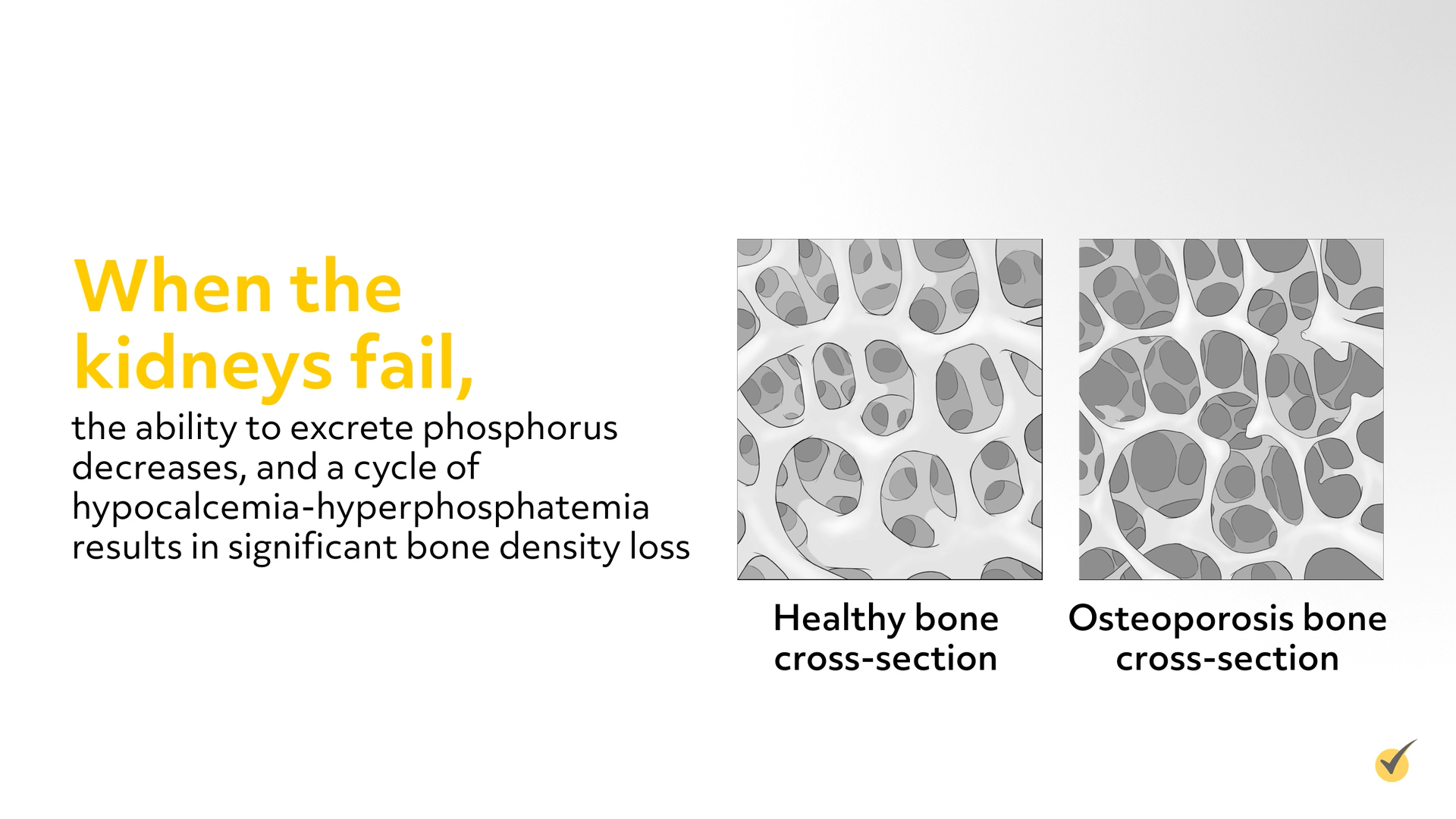 Example of bone density loss. There is a healthy bone cross-section, and a osteoporosis bone cross-section. While the healthy bone has a thick structure, the osteoporosis bone is deteriorated and weak. 