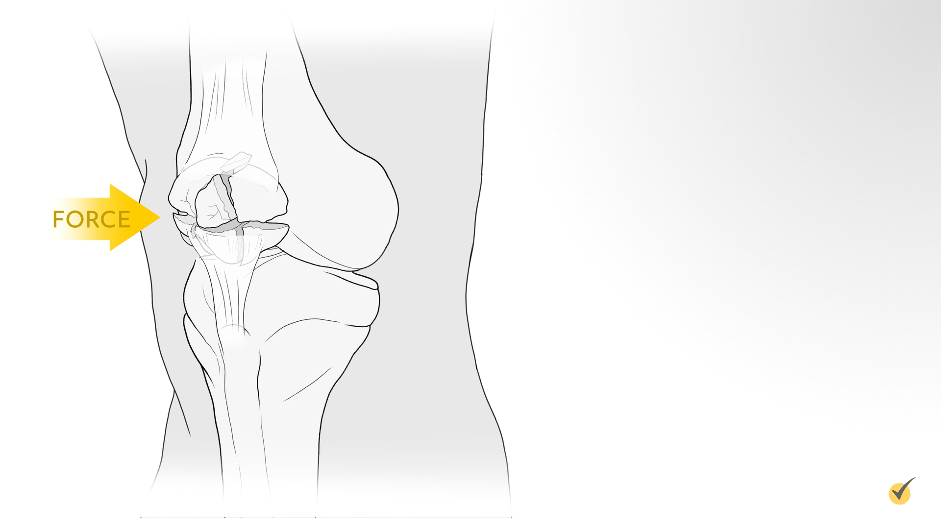 Example of force breaking the patella
