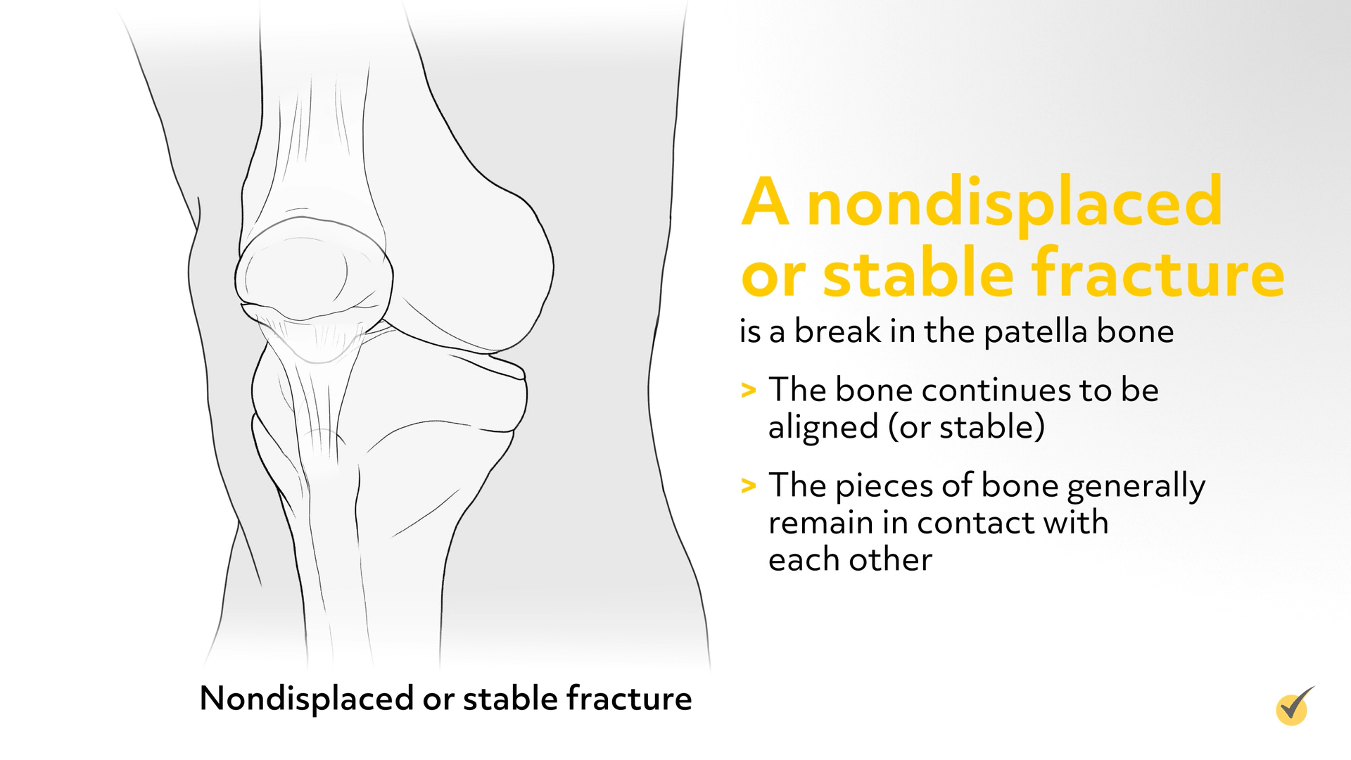 Image of a nondisplaced or stable patellar fracture. The bone is still stable with the pieces of the bone intact.