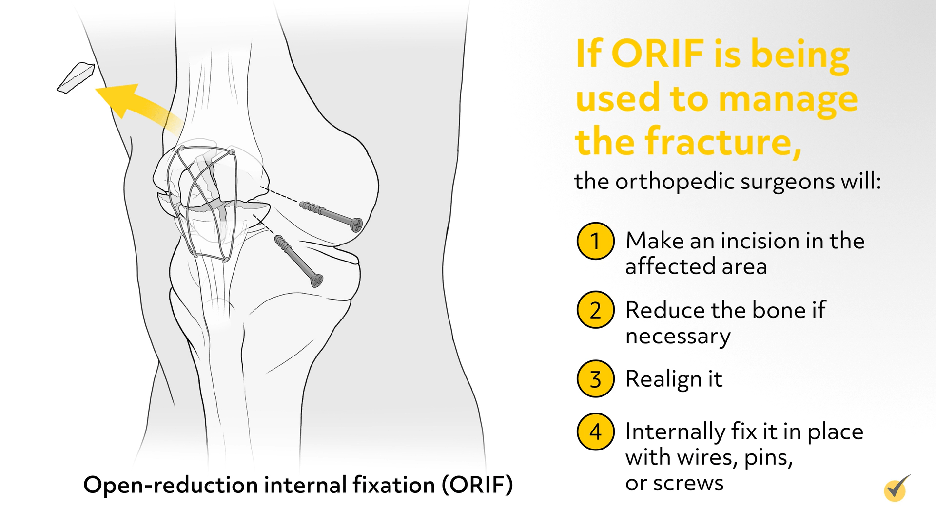 Example of what an Open-reduction internal fixation would look like. Screws, wires, and bands hold the kneecap together.