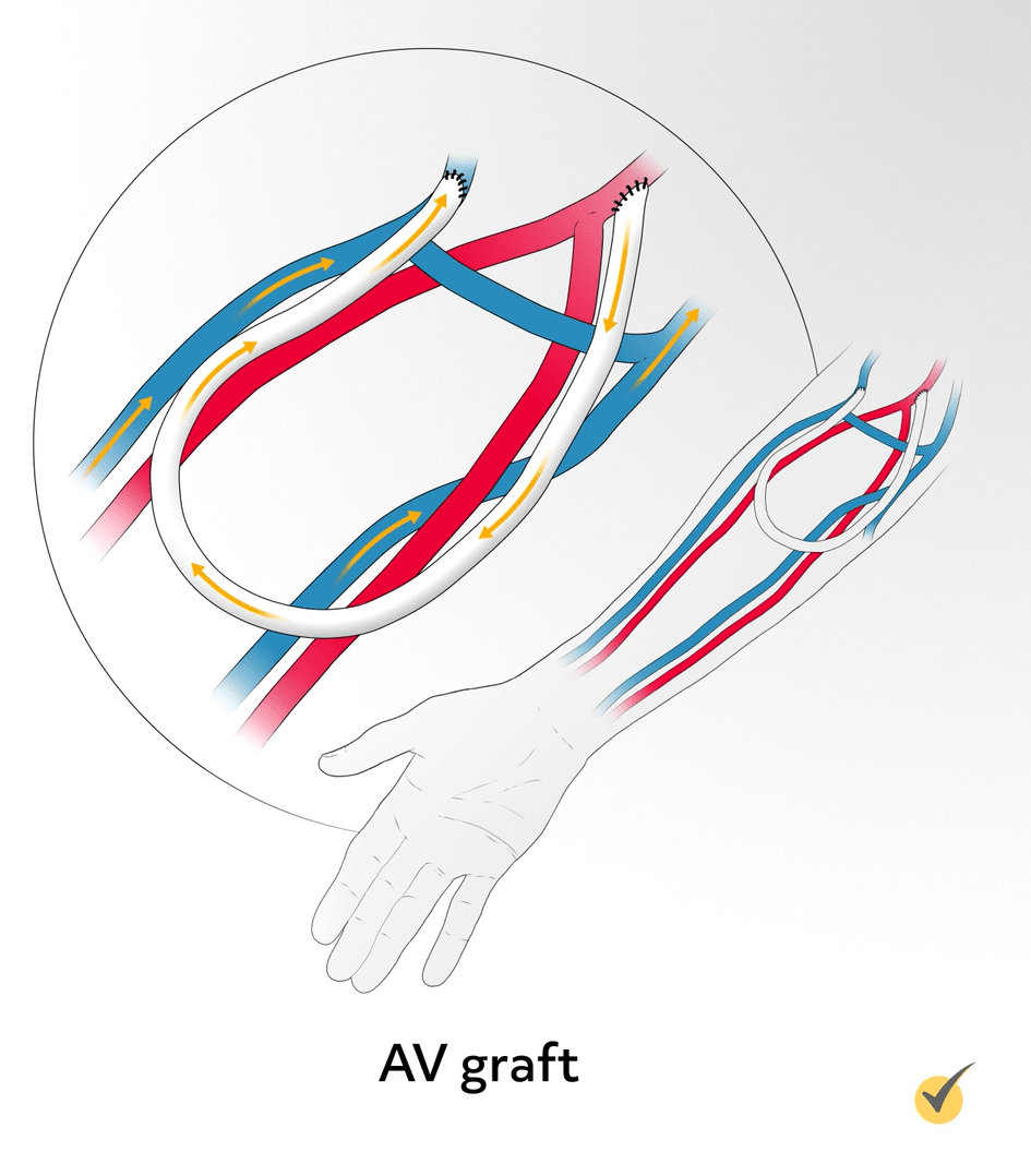 Image of an AV graft; a tubing surgically implanted in the patients upper forearm that attaches to an artery and a vein. 