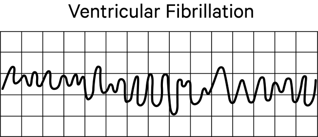 Ventricular Fibrillation