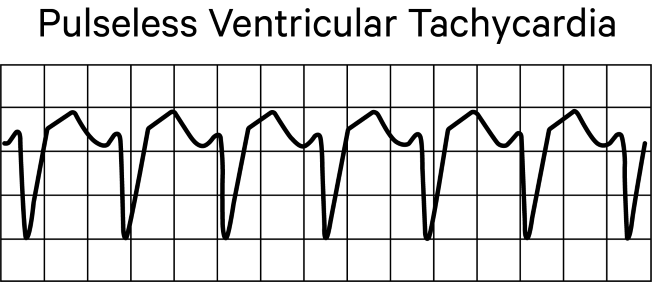 Pulseless Ventricular Tachycardia